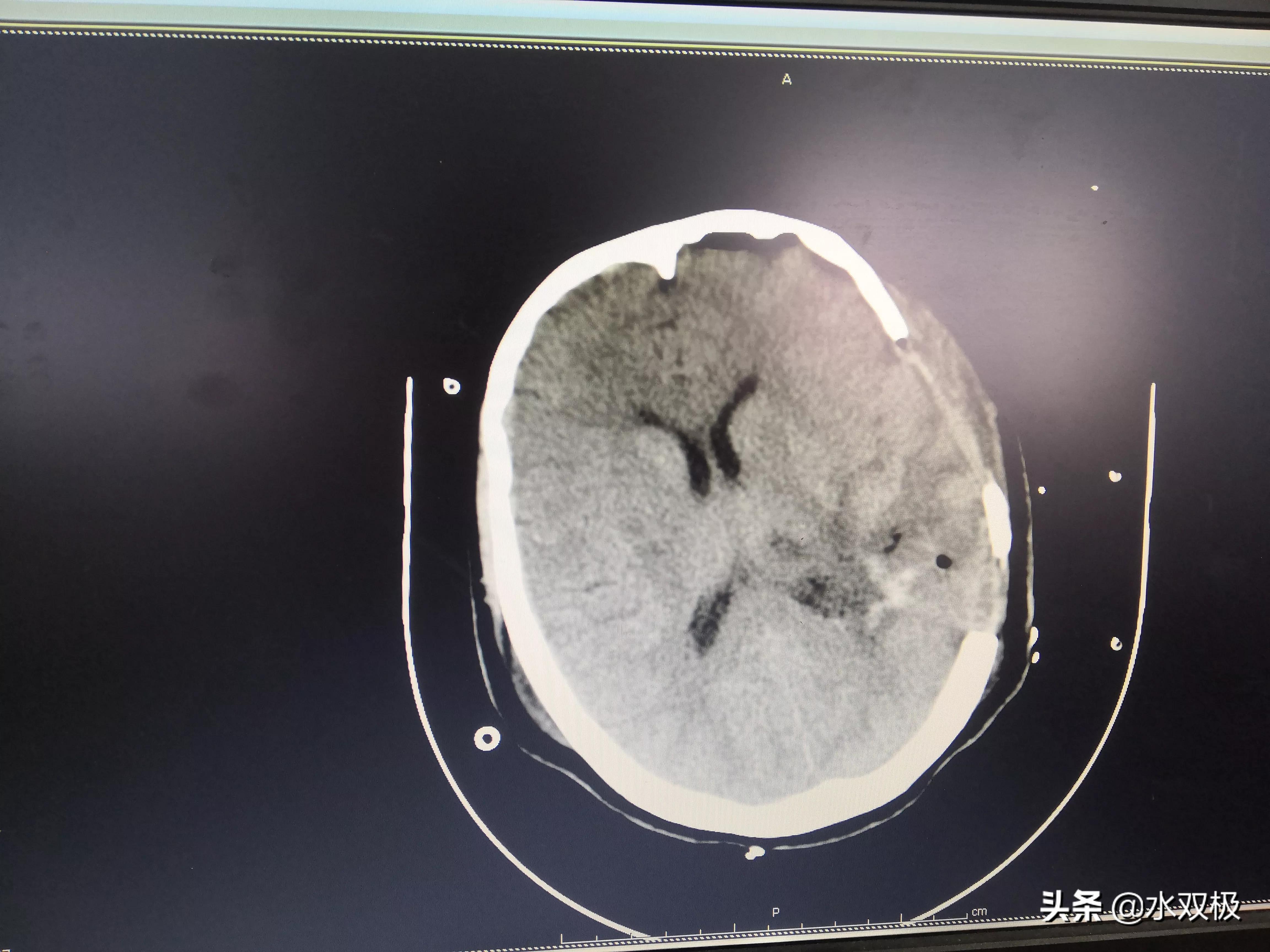 開顱血腫清除術(腦出血開顱血腫清除)