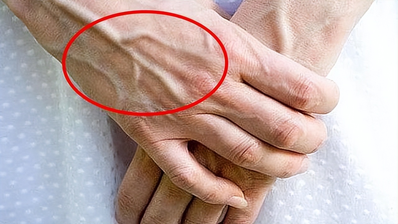 有些人手臂"青筋暴起",有些人却看不到"青筋",医生为你科普