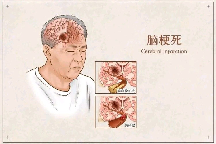 颈动脉斑块，怎么查？怎么治？别吃哪种水果？本文为您全讲清