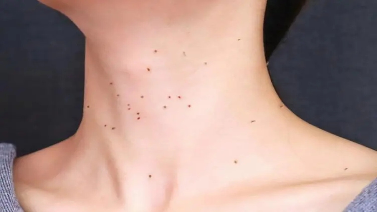 hpv是一种人乳头瘤病毒,当这种病毒与人体的在皮肤所接触后,会形成一