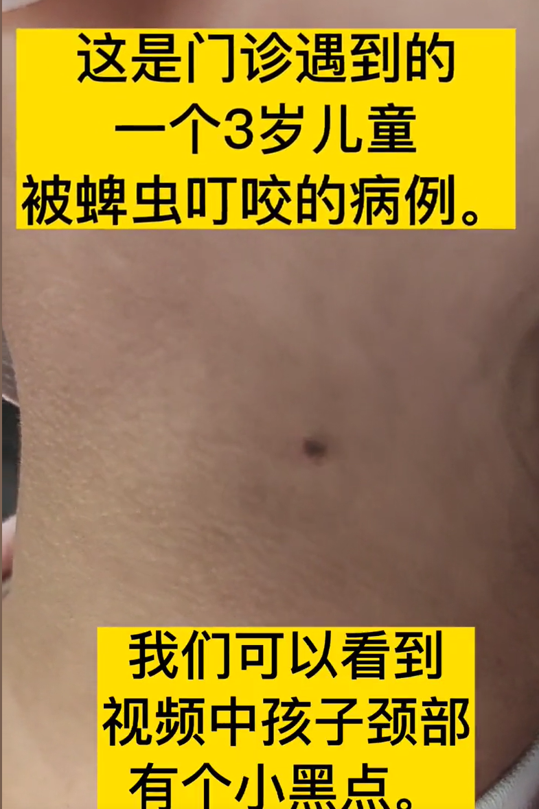 4岁孩子被蜱虫咬,妈妈"4步法"处理显智慧,医生:回家观察就行