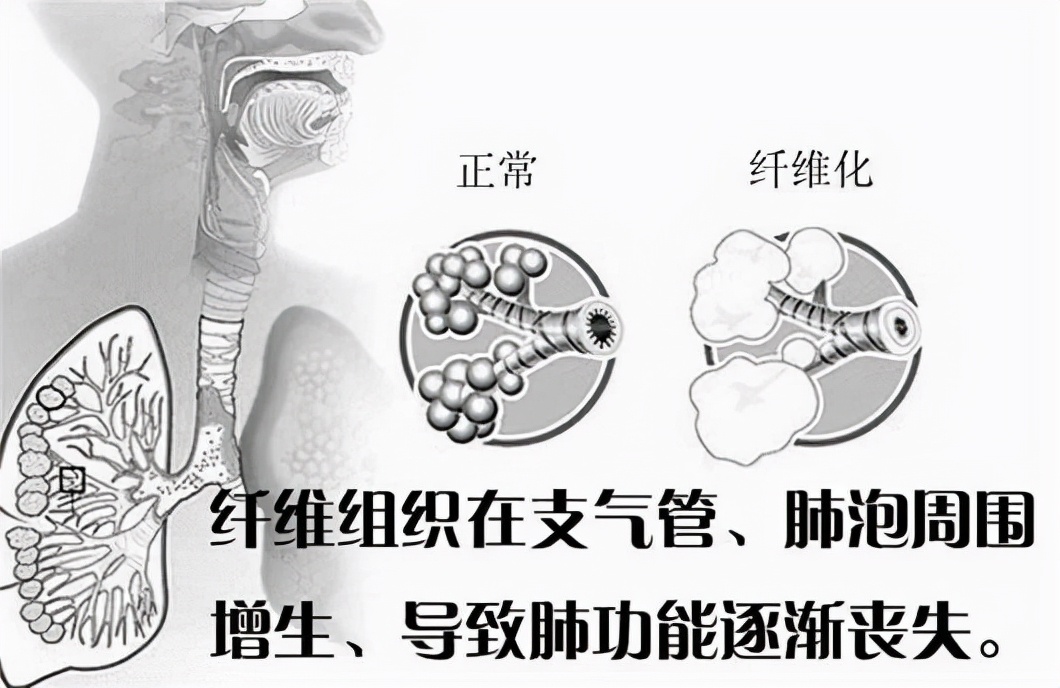 河北18岁少女被姐夫投毒百草枯，为何12天后才发现中毒？