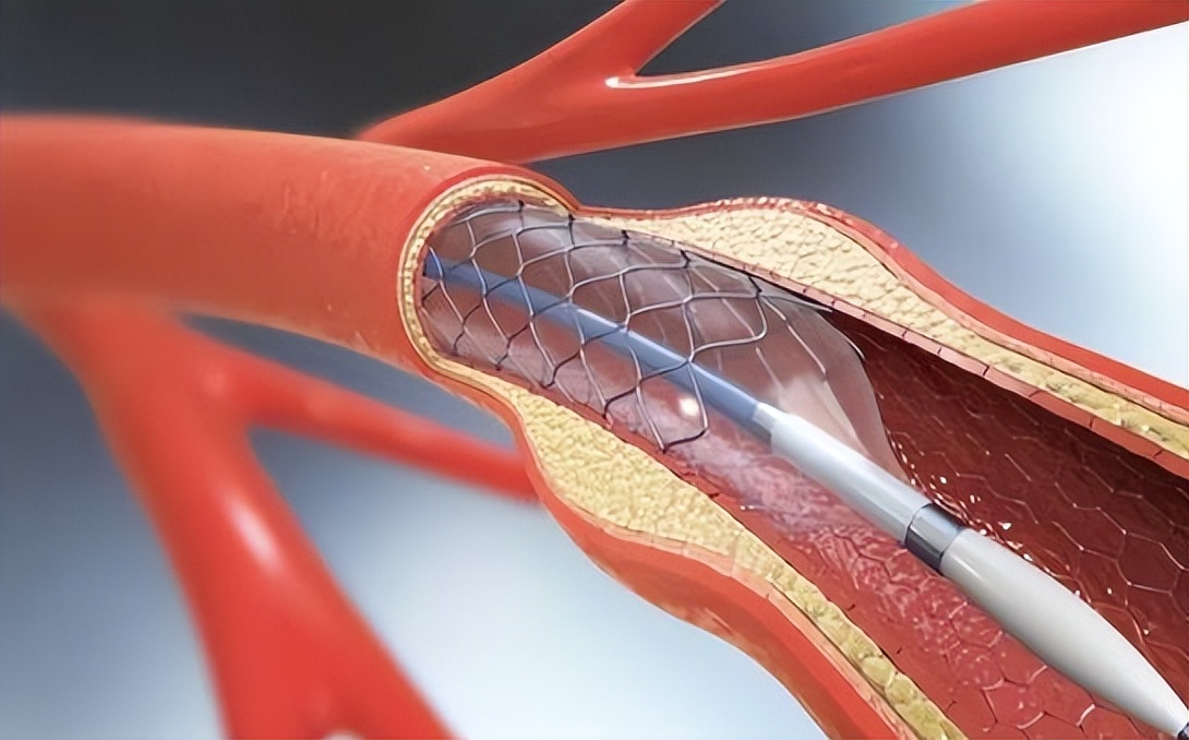 从2万降到几百,心脏支架仍有"价格困局",有钱也"一架难求"