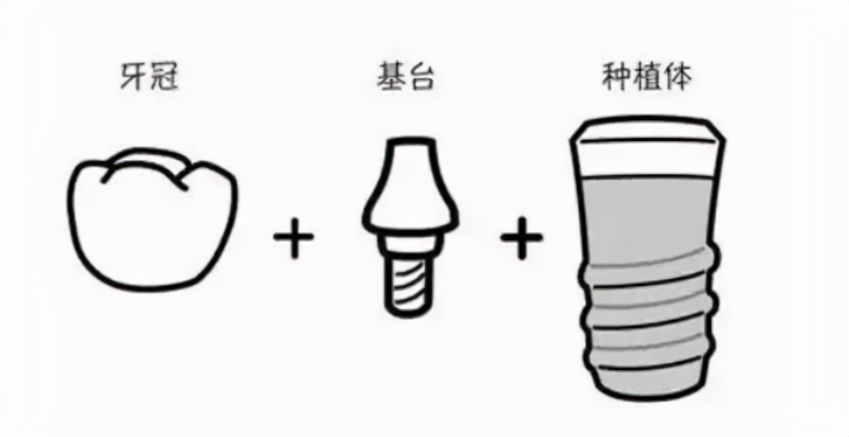 北京房山一颗种植牙多少钱？