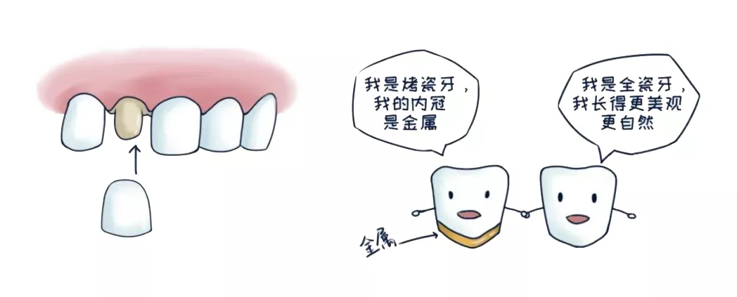 一字之差,价格翻了10倍!全瓷牙凭什么比烤瓷牙贵?