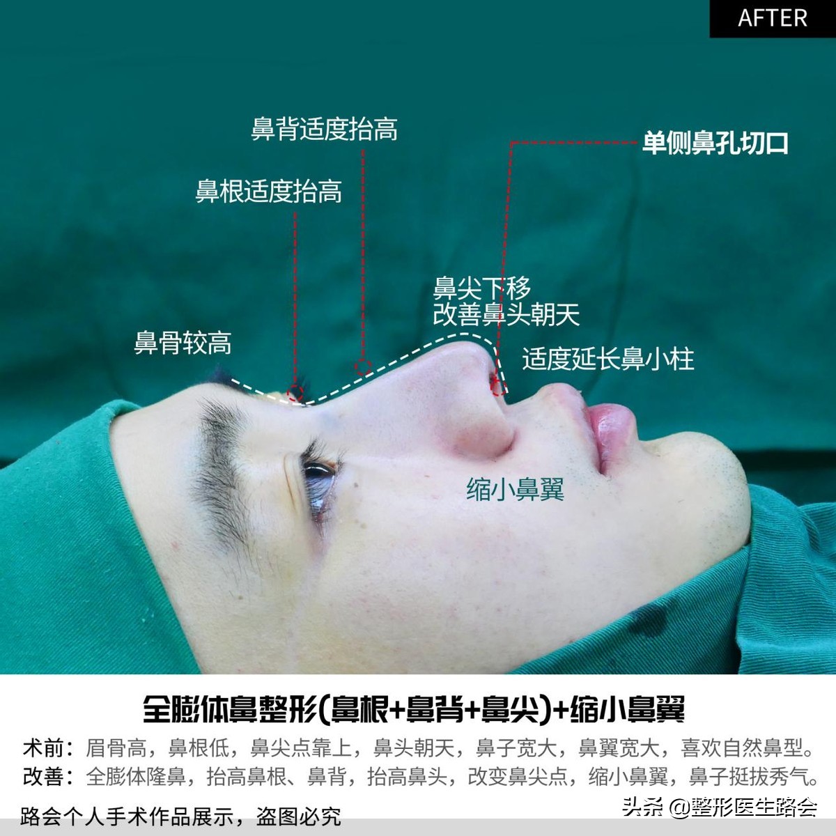 等待2年之久，从海南到北京，鼻整形真实记录，82天后“很惊艳”