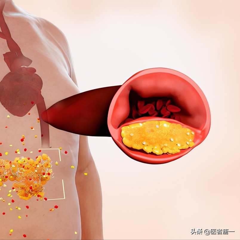 做冠脉造影检查后寿命变短？听听医生怎么说