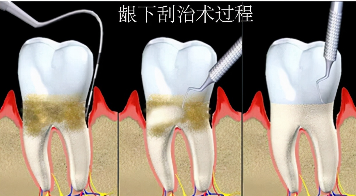 牙龈反复发炎、肿痛？3个原因作怪，警惕出现全身性并发症