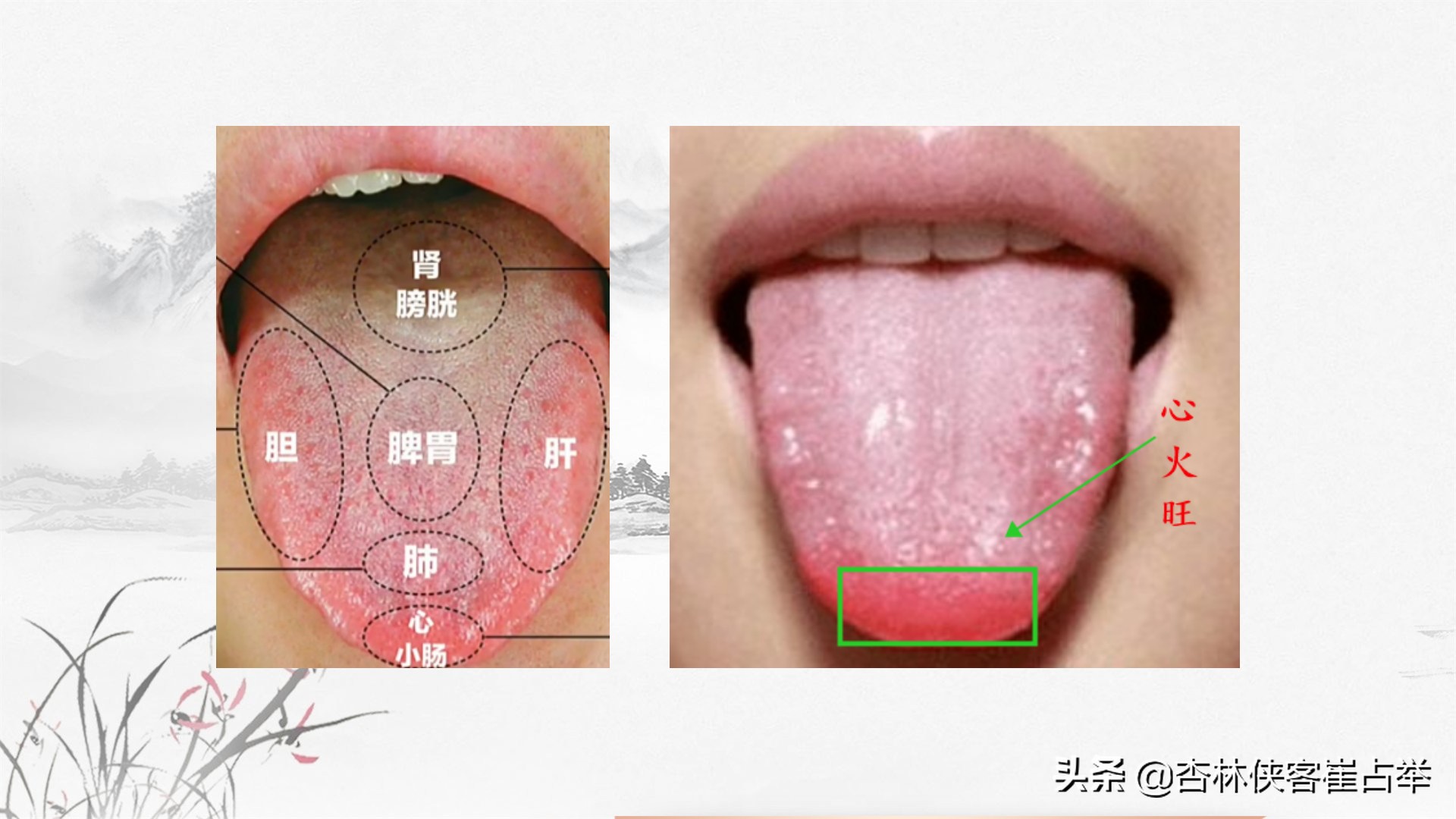 大家可以看一下粉絲髮來的舌象圖片,看看他有什麼特點,你看他的舌尖是