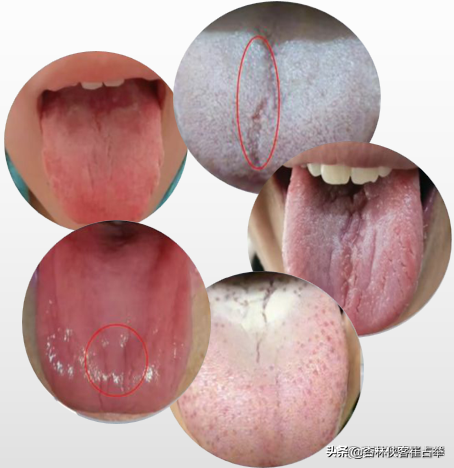 首先我们先来了解一下什么叫裂纹舌,你可以把舌头伸出来看一下,是不是