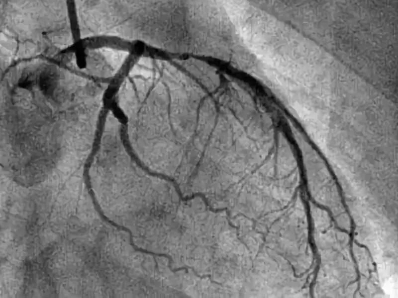 做完冠脉造影，患者就活不久了？劝告：4种人别轻易尝试