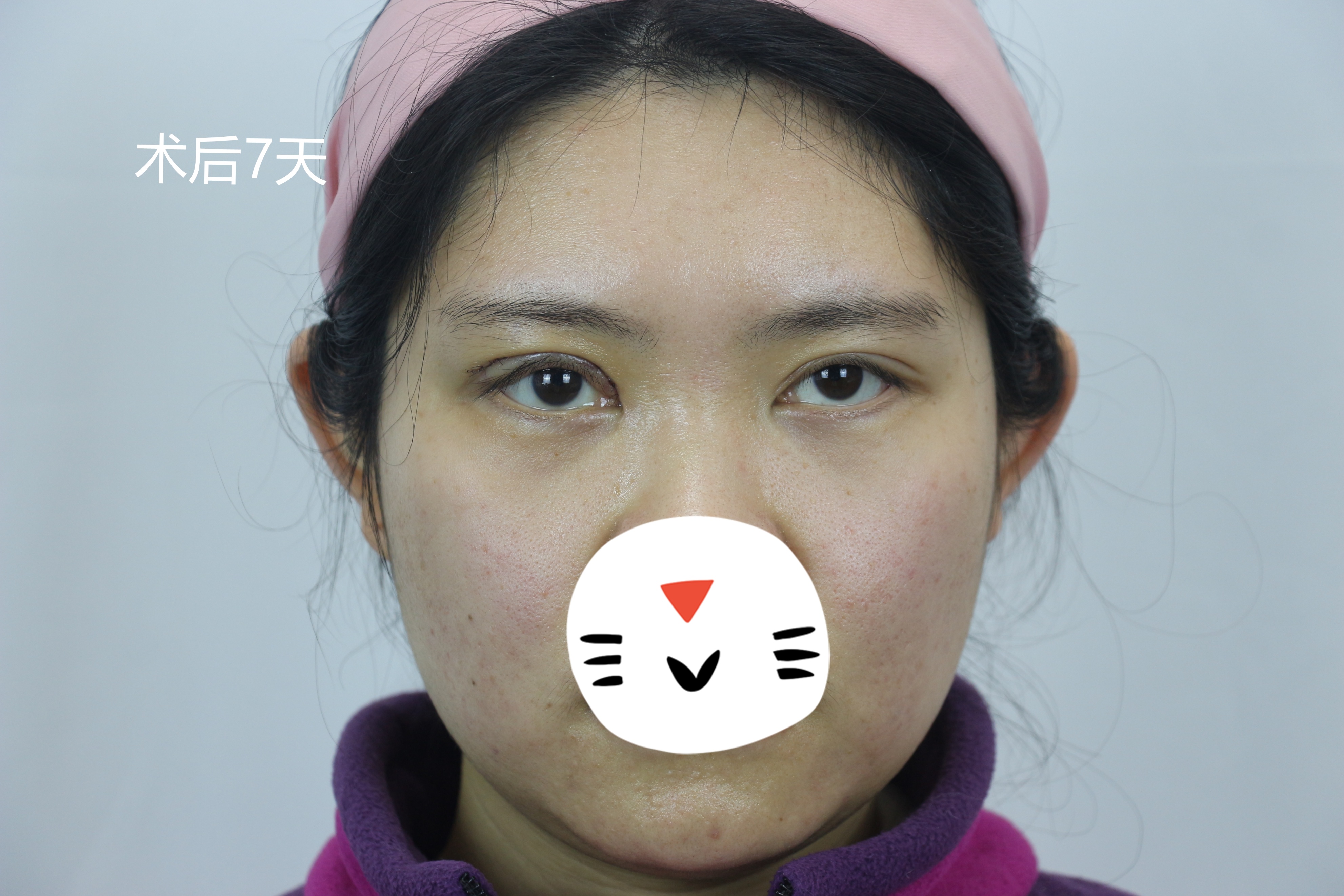 河北90后姑娘右眼上睑下垂做了一次效果不好,来找我们做了修复