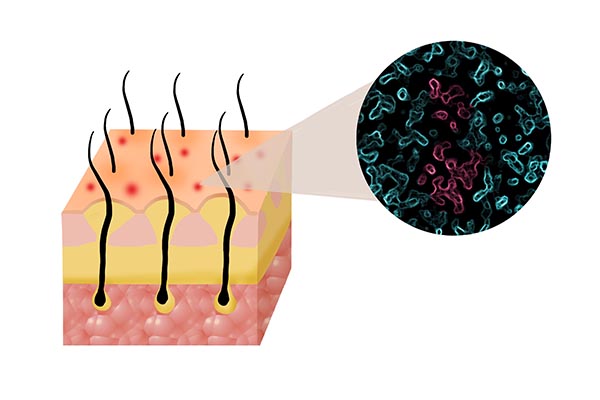 为什么头皮屑非常多？是病吗？洗发水成分和洗头习惯也要注意