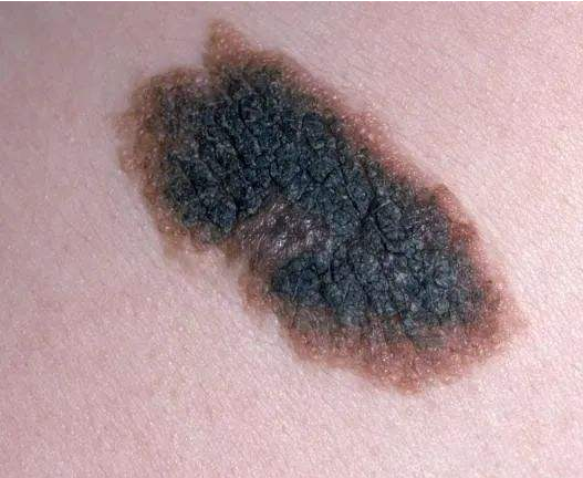 有胎记的宝宝(每个宝宝都有胎记吗)