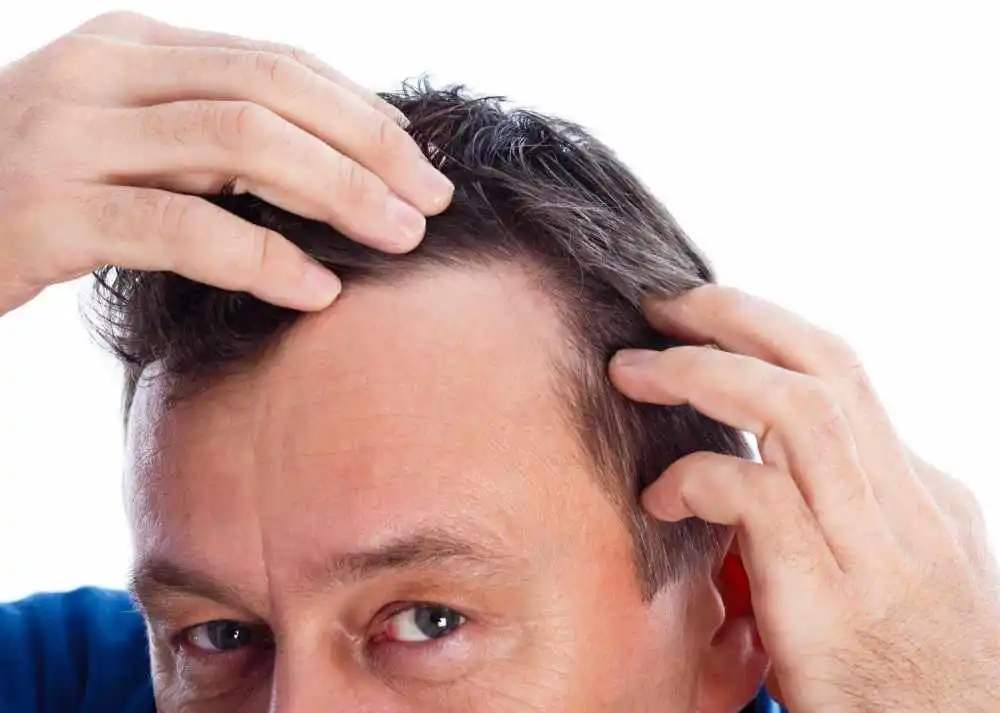 戴帽子会导致脱发秃顶？脱发这件事男性激素很关键，如何预防？
