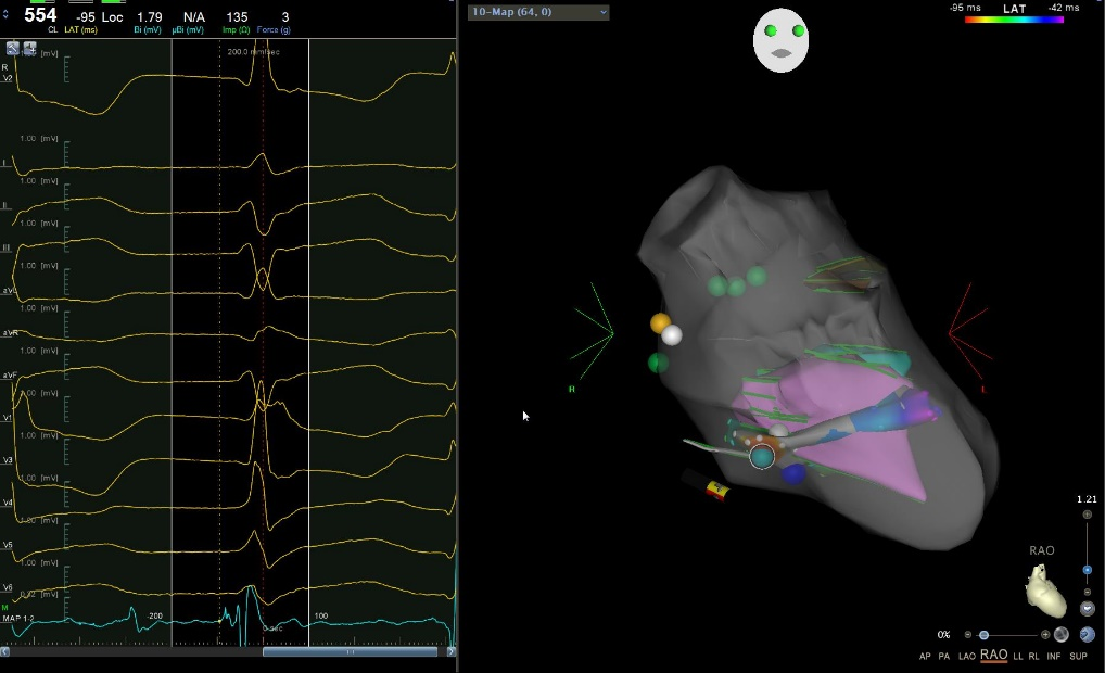 仁医病例丨方哲参与指导多例疑难性室早射频消融治疗