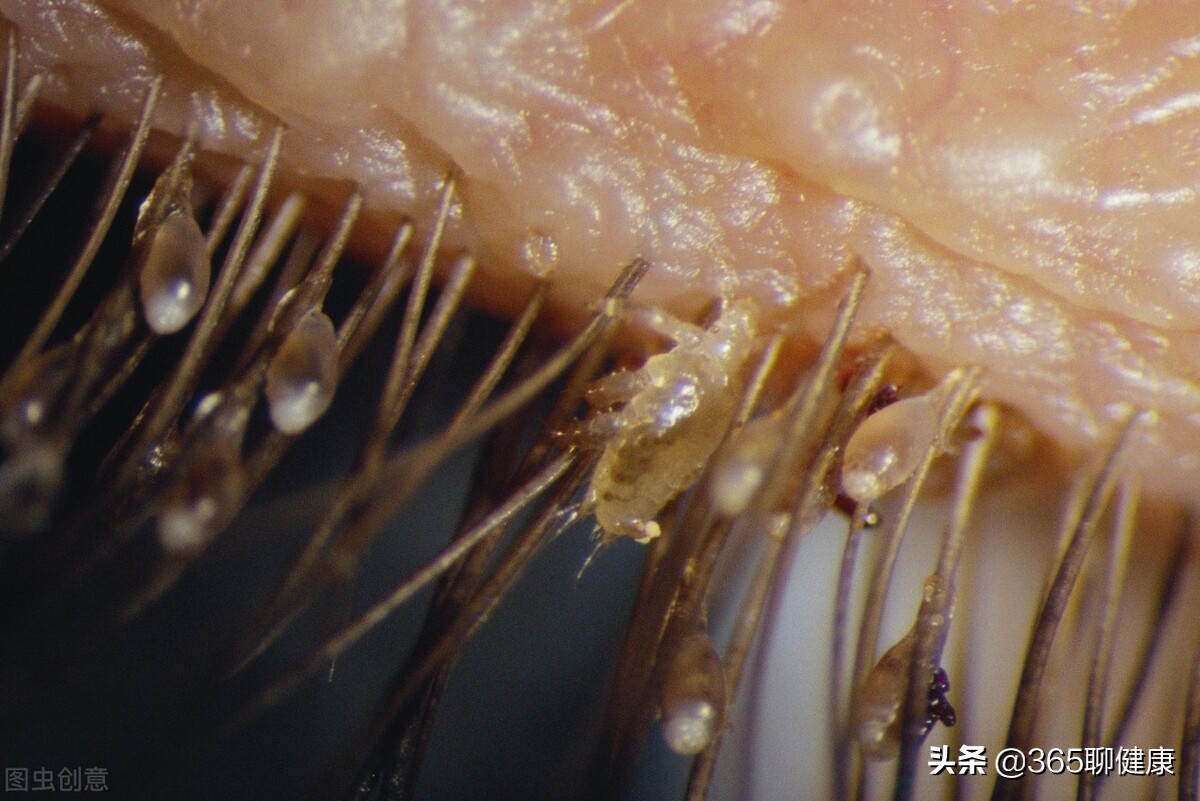 为何有的女孩会被阴虱盯上?与这2点有重要关系