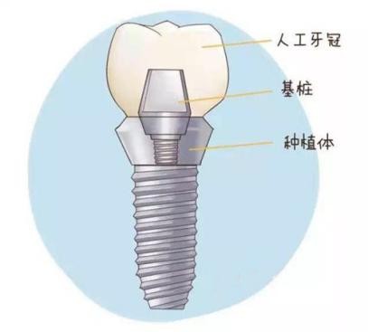 「牙齿那些事儿」No.125丨同样是种植牙，为什么价格差距那么大？