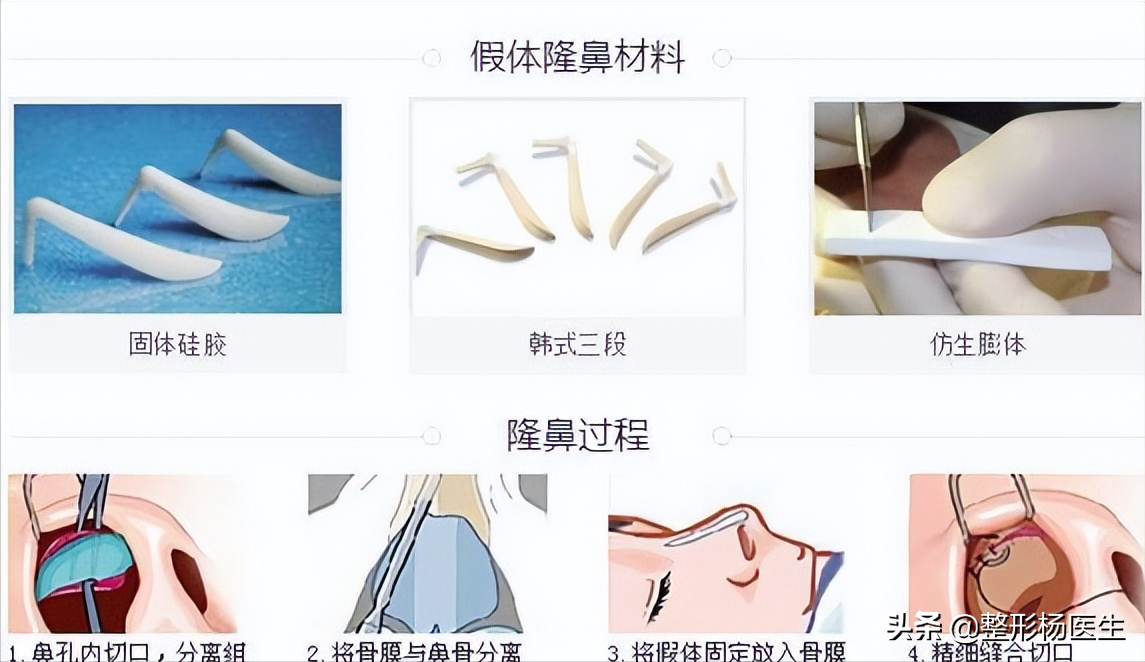 想要隆鼻！隆鼻手术种类形形色色，究竟怎么选？