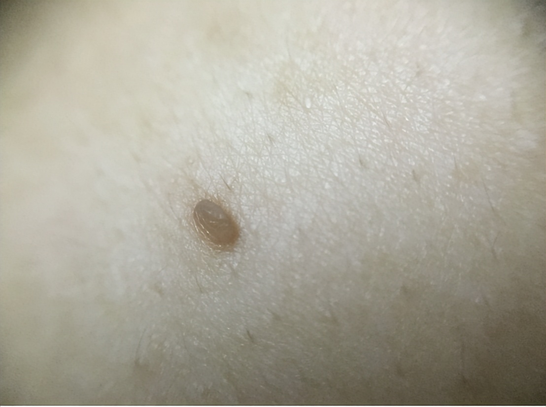 颈部毛囊炎颈部毛囊炎是因为细菌感染所导致的,一般是在颈部出现凸起