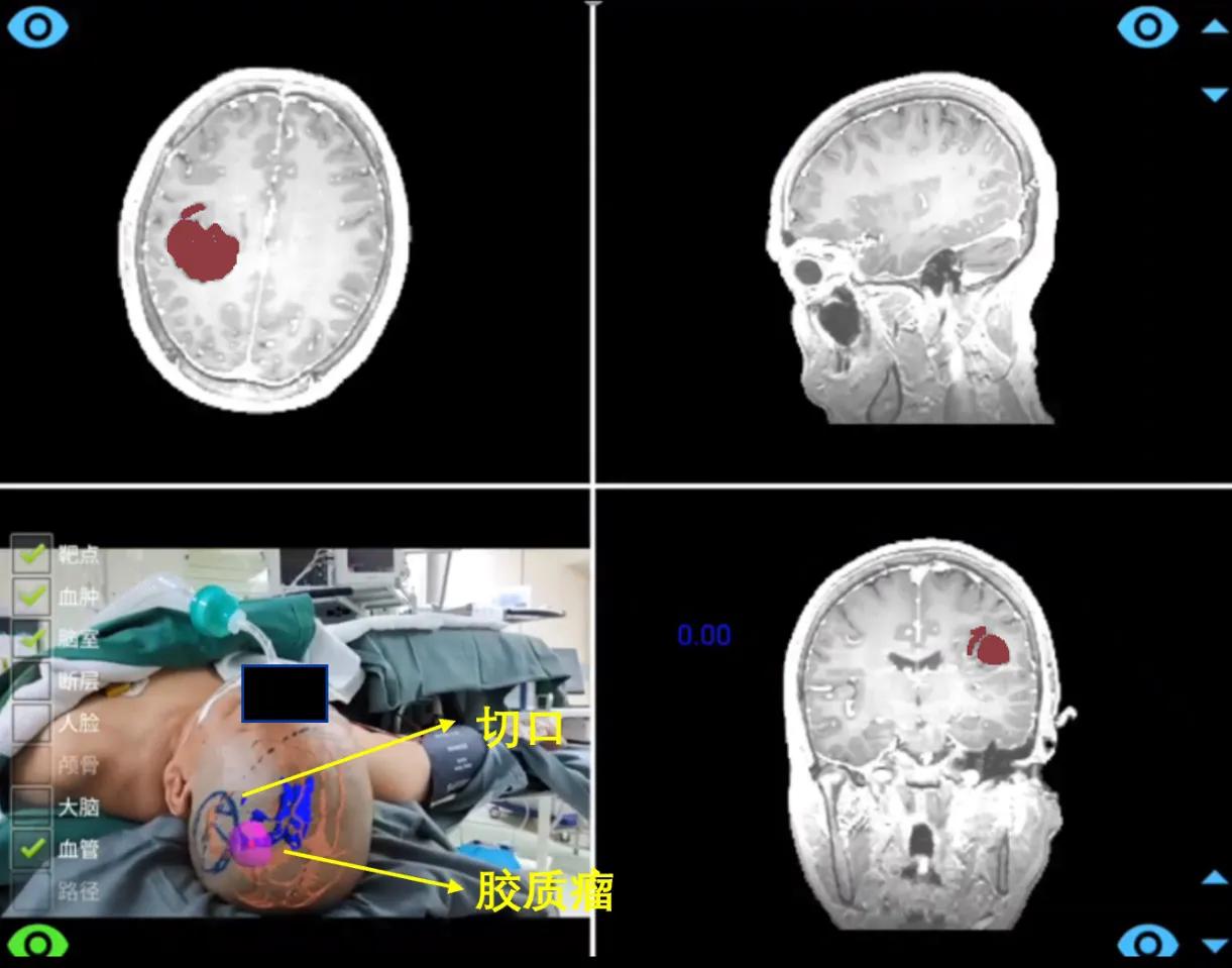手术配上GPS 北京协和医院与腾讯联合发布国产手术导航系统