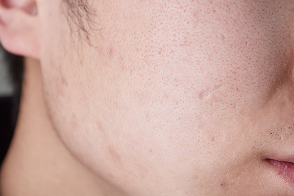 皮肤癌有哪些前兆？从皮肤看癌症，三种状况要警惕