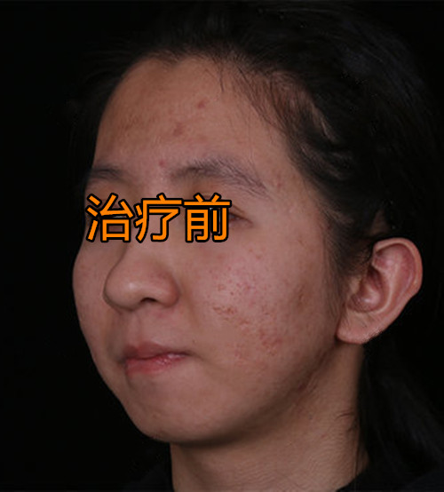 张女士激光治疗后，5年痘坑痘印彻底消失，现在感觉自信了很多