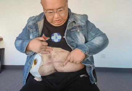 南京胖哥见义勇为后失去肛门功能，希望二次手术后，能恢复健康