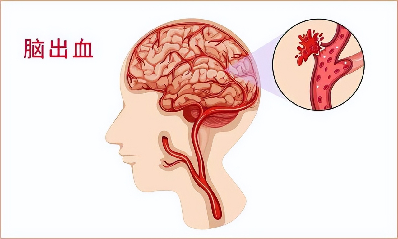 胆固醇越低，癌症风险越高吗？要怎样控制血脂健康？建议看看