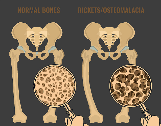 老年人常常下肢无力？可能是这5个原因导致的，医生教您如何应对