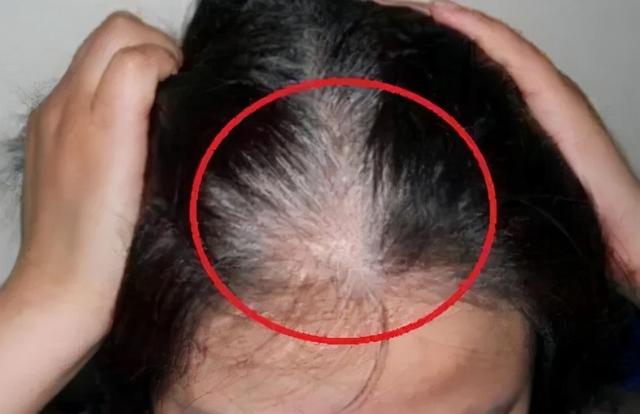 白发长出和疾病有关吗？长在前额、两鬓、后脑勺，分别说明了啥