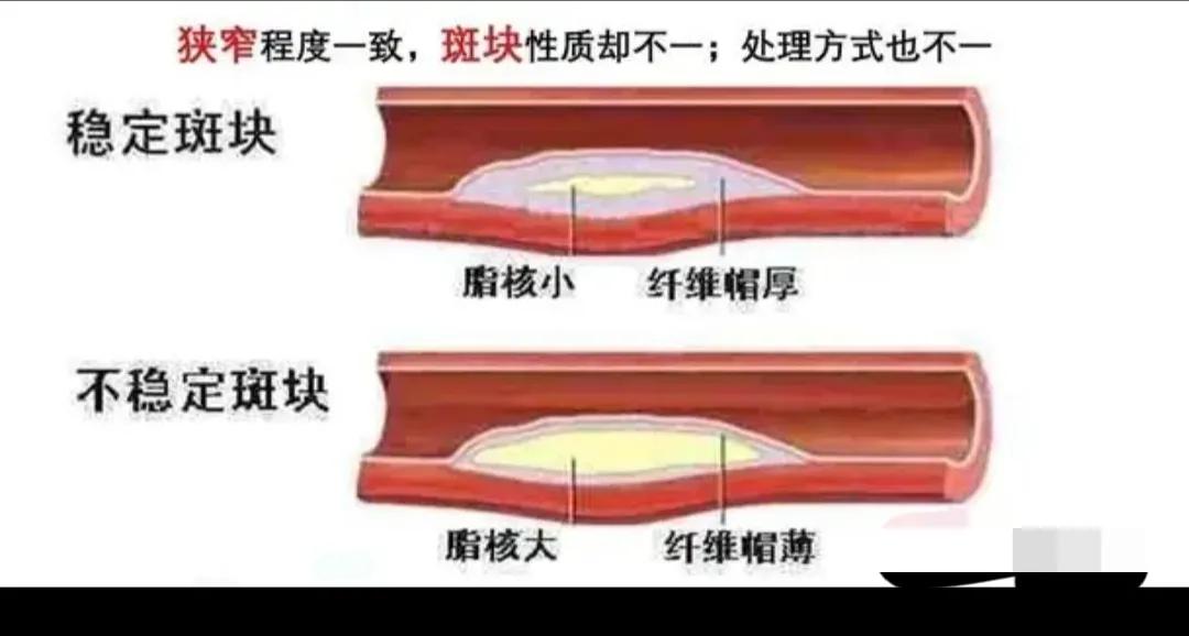 坚持7年，颈动脉斑块“消失”，4种方法“护血管”，真的可以做到