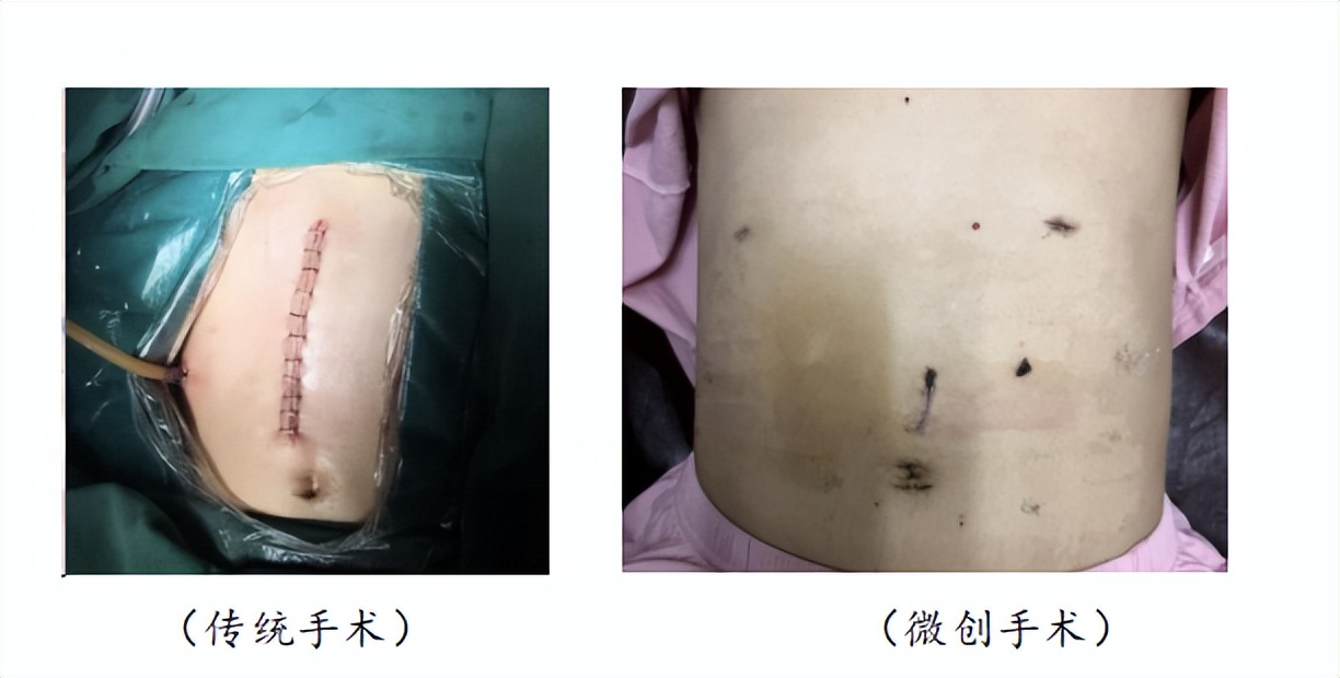 小戳口治大病——腹腔镜下胆总管囊肿切除术+胆总管空肠吻合术