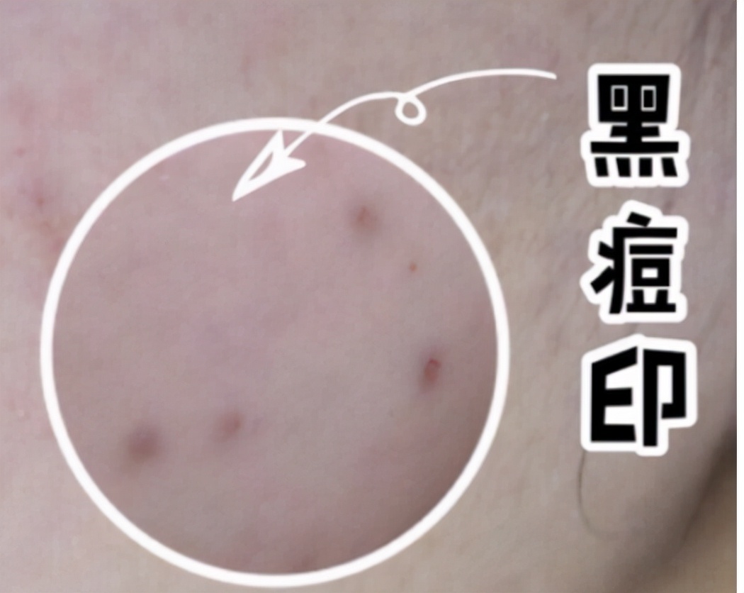 黑色痘印图片(常见的) - 赤虎壹号
