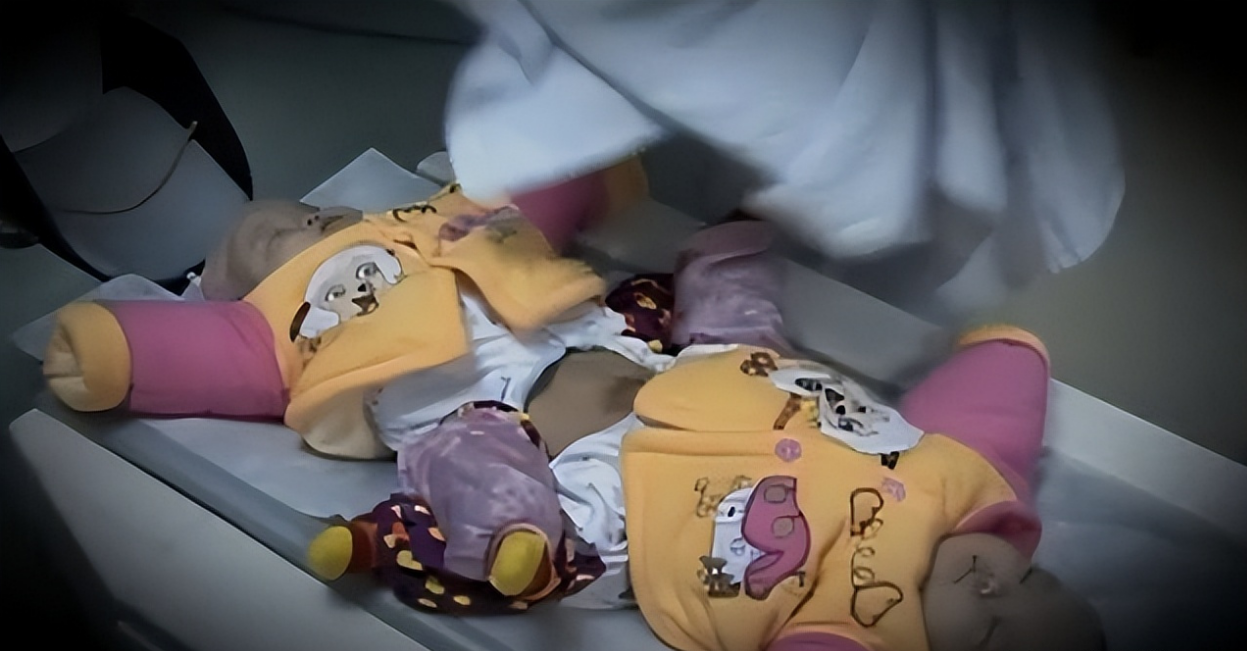 连体婴儿图片(2009年) - 乐宝宝贝