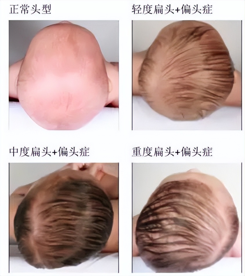 人体头颅的正常形态为圆球形,婴儿的头颅发育未完全,若睡扁平头则会