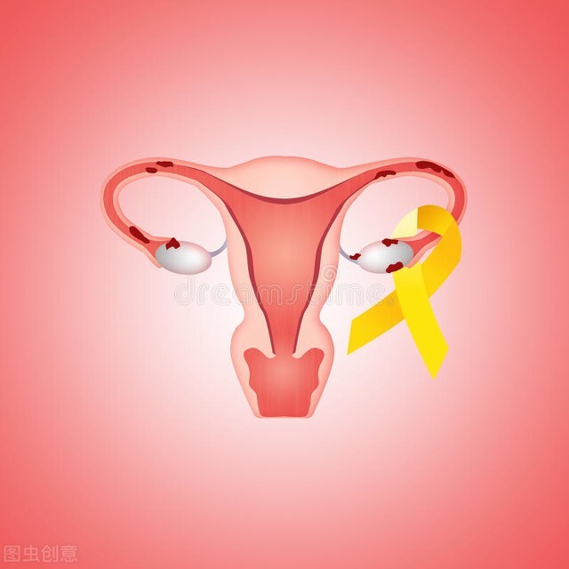 子宫腺肌病合并巧克力囊肿的治疗方案