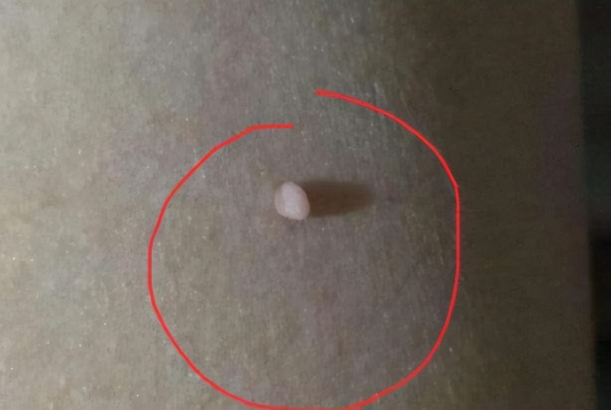 脖子和腋下的"小肉粒"是什么?能直接用手揪掉吗?看完要记牢