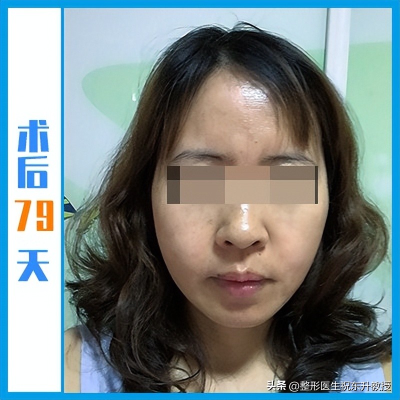 48岁把拉皮手做了，术后16天-120天，无P图 不美颜 真实反馈