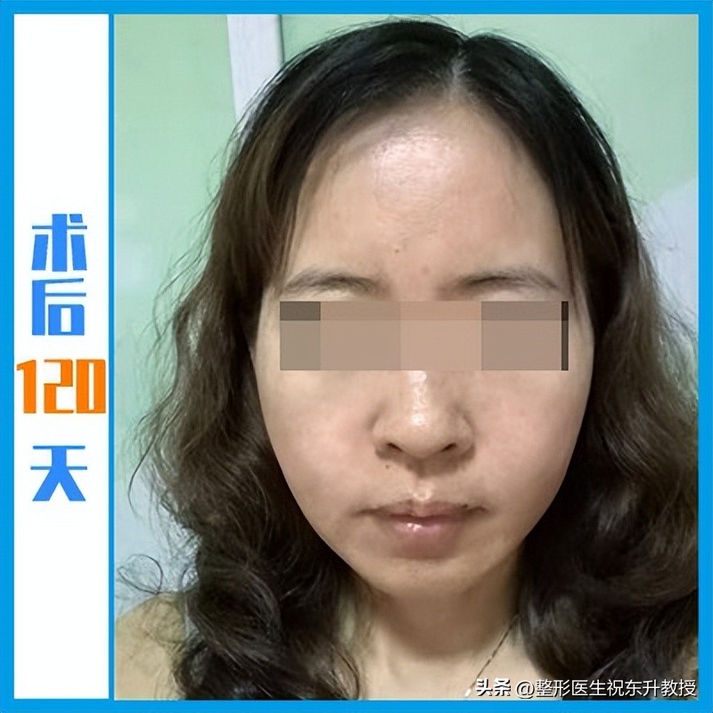48岁把拉皮手做了，术后16天-120天，无P图 不美颜 真实反馈