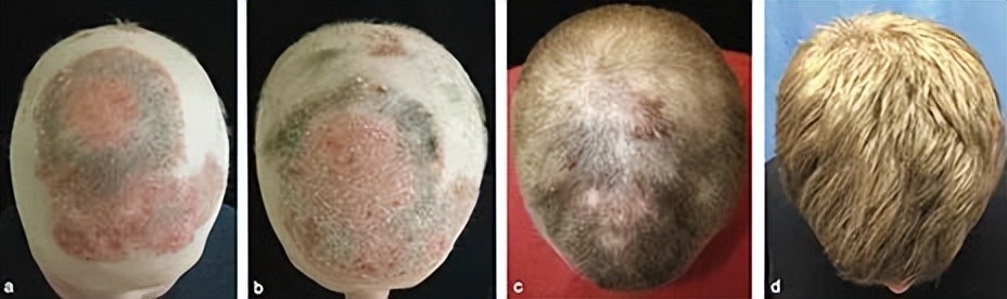 这种脱发症有如毁容，专门困扰年轻人，科学家意外发现治愈方法