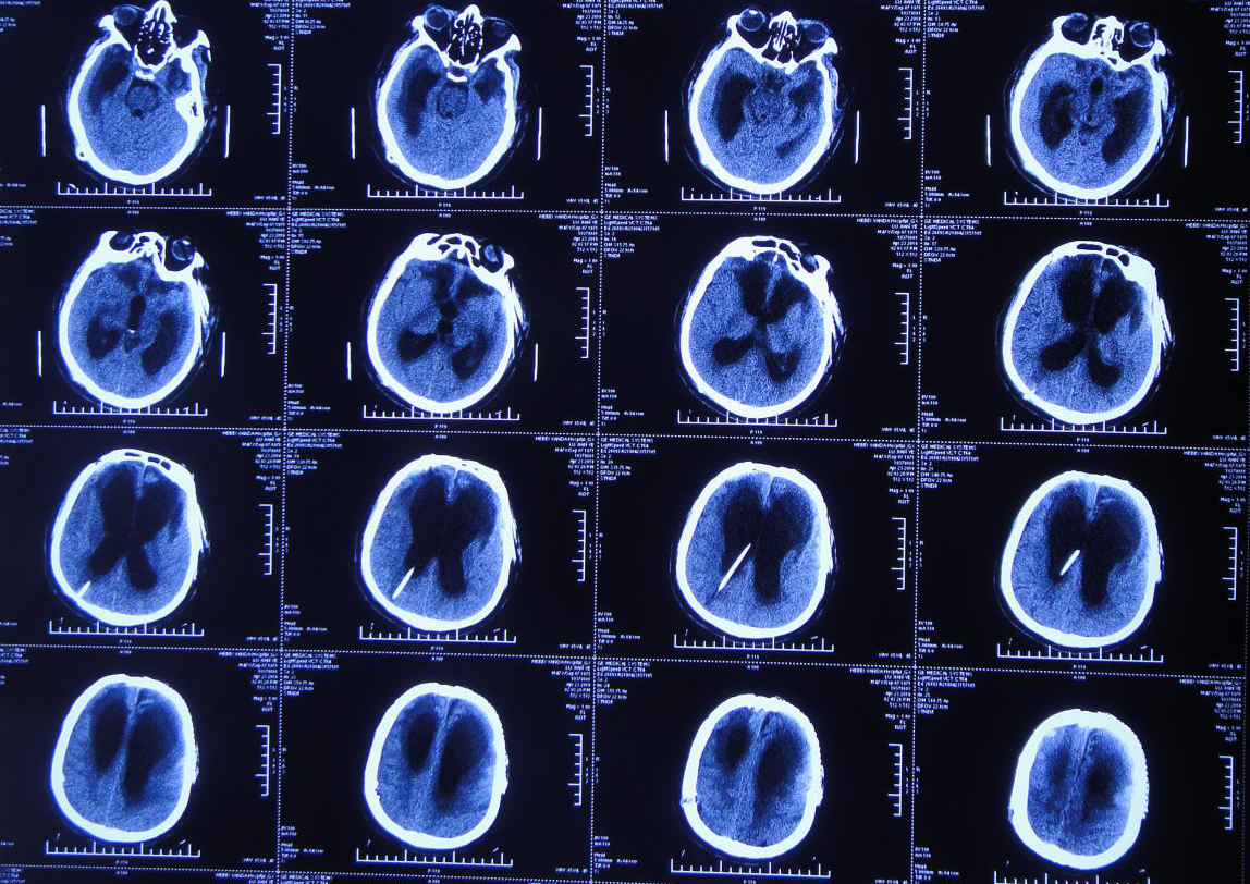 脑外伤颅骨修补术和分流术后脑积水加重致昏迷