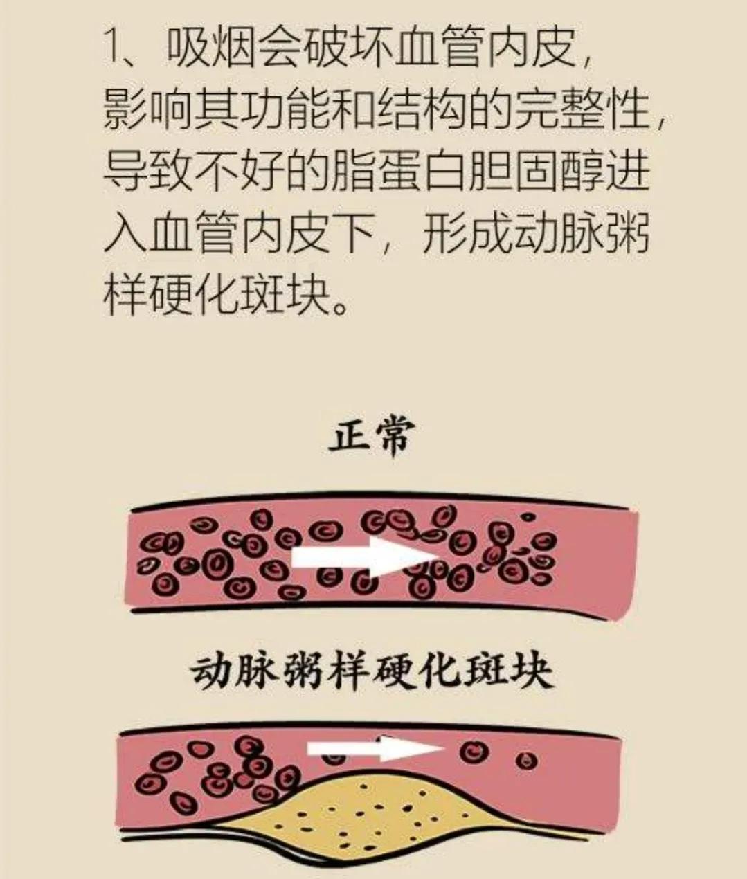 红酒、鱼油会软化血管？保护血管要做好以下3点，血管健康更长寿