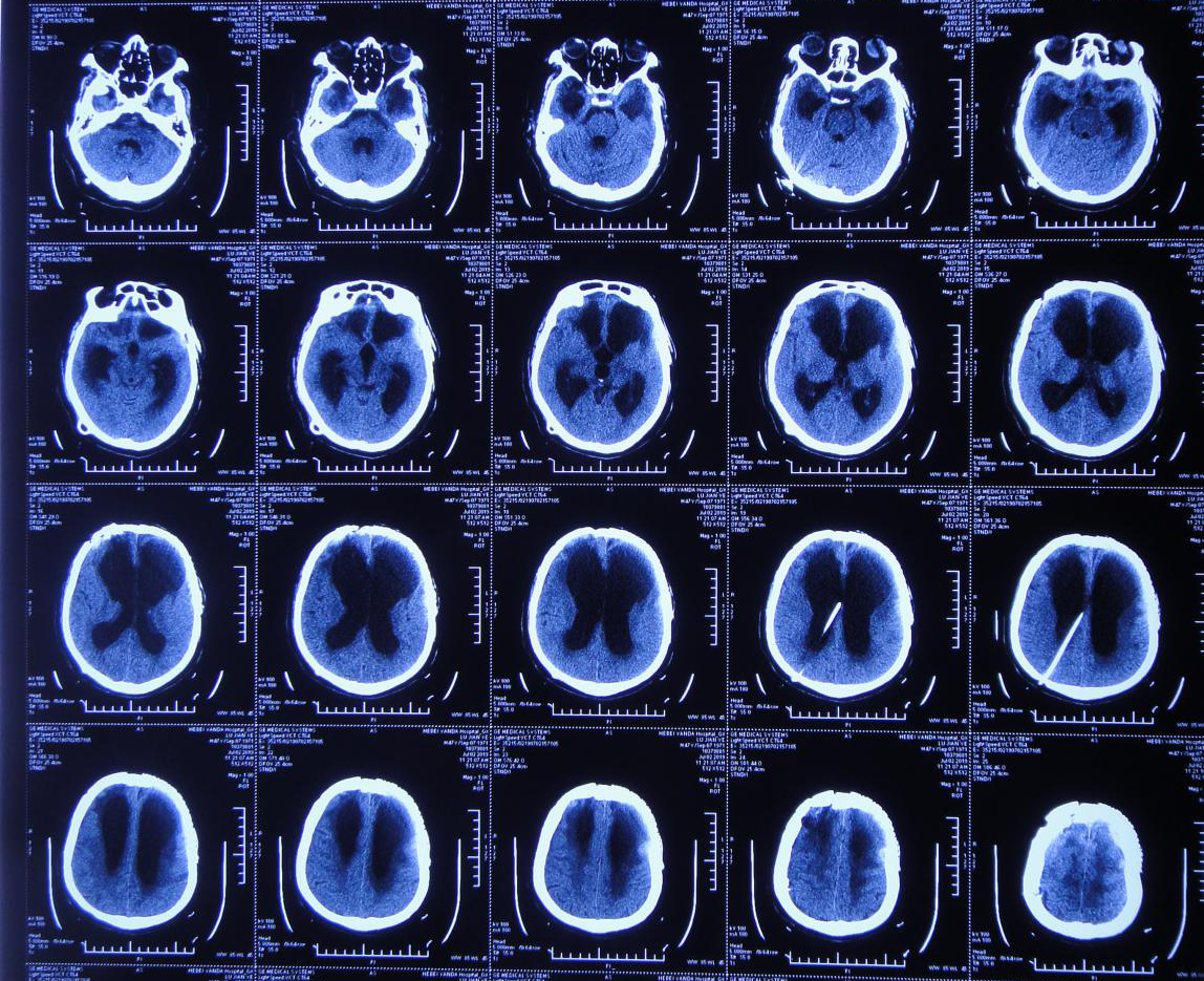 脑外伤颅骨修补术和分流术后脑积水加重致昏迷