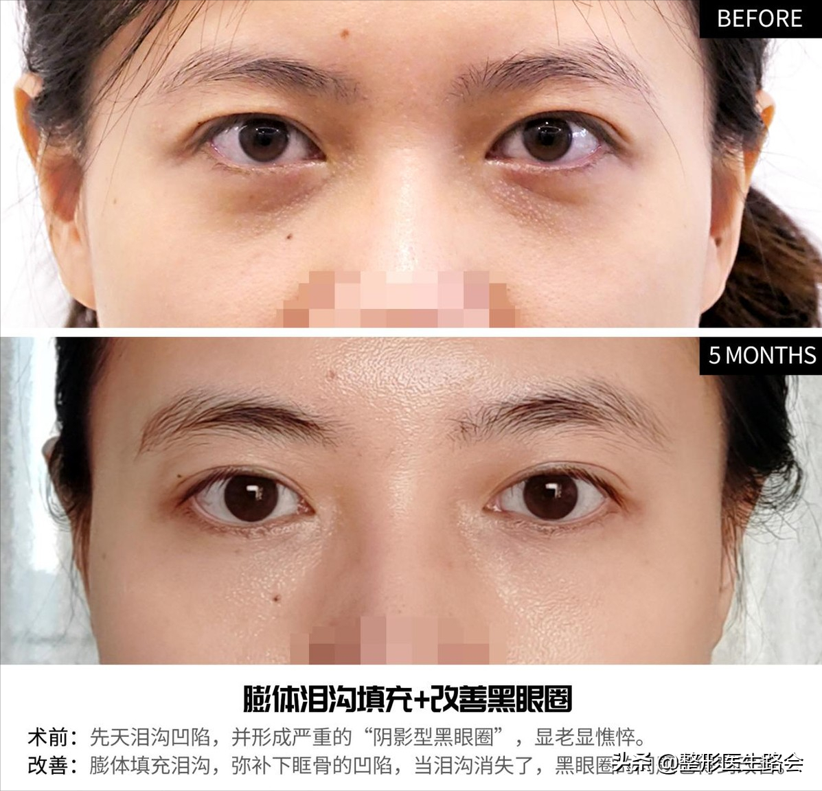 单纯泪沟 结构型黑眼圈效果对比