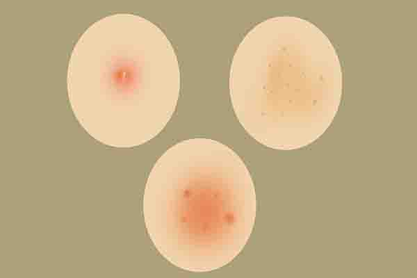 皮肤癌有哪些前兆？从皮肤看癌症，三种状况要警惕