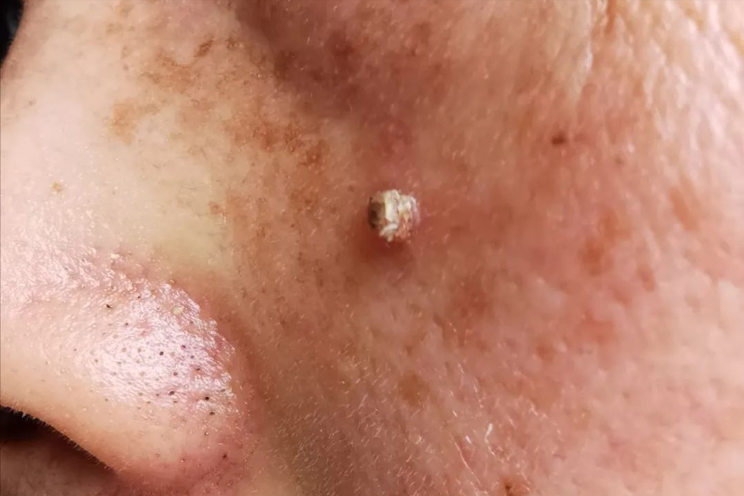 hpv是一种dna病毒,长成小球状(45-55nm),为无包膜的20面立体,有72个壳