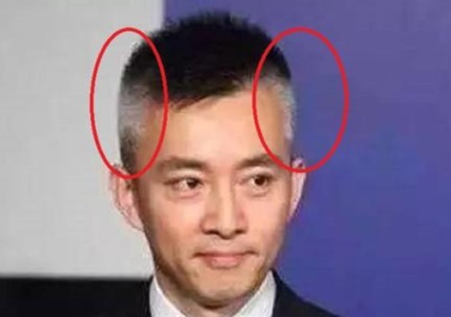 白发长出和疾病有关吗？长在前额、两鬓、后脑勺，分别说明了啥