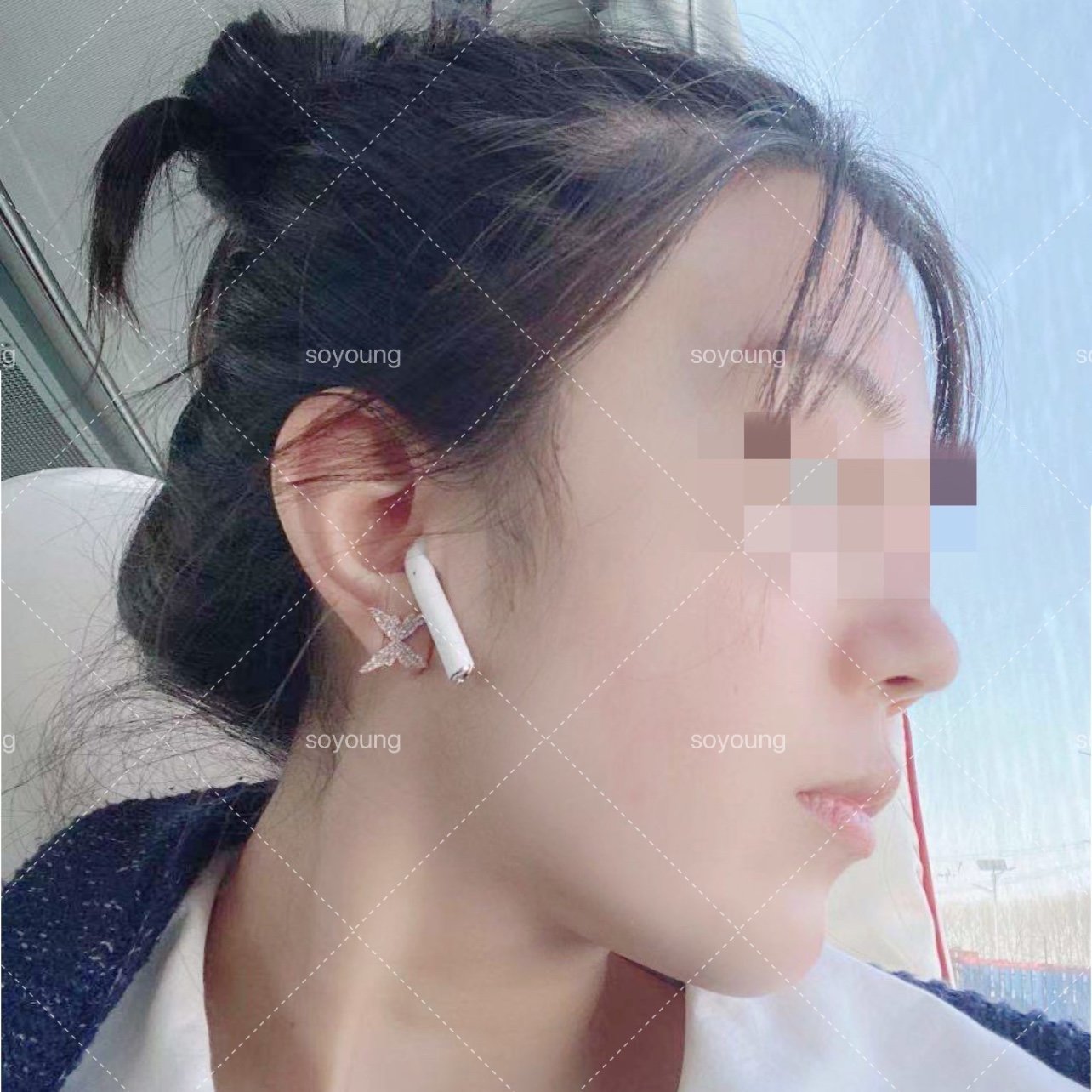 面頰抽脂多少錢(30歲的張女士面部吸脂) - 價格百科