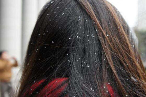 为什么头皮屑非常多？是病吗？洗发水成分和洗头习惯也要注意
